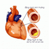 Bệnh động mạch vành và cách điều trị
