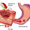 Tìm hiểu chi tiết về bệnh viêm dạ dày