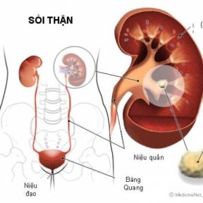 Bệnh sỏi hệ tiết niệu và cách điều trị