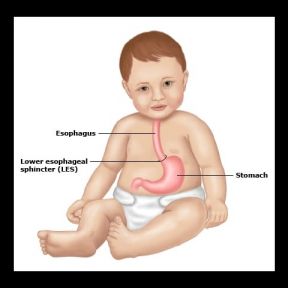 Bệnh trào ngược axit dạ dày ở trẻ