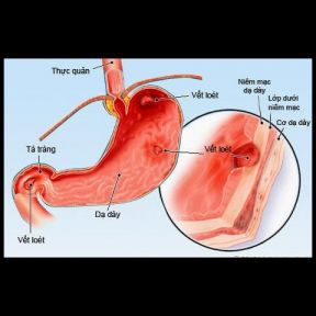 Bệnh viêm dạ dày