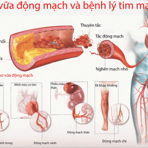 Bệnh xơ vữa, xơ cứng động mạch