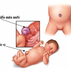 Thoát vị rốn và những điều cần biết