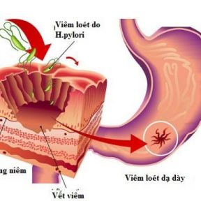 Tìm hiểu chi tiết về bệnh viêm dạ dày