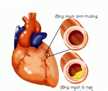 Bệnh động mạch vành và cách điều trị