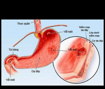 Bệnh viêm dạ dày