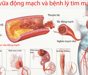 Bệnh xơ vữa, xơ cứng động mạch