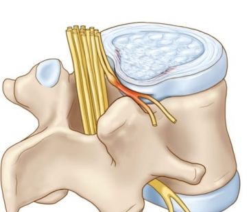 Chèn ép dây thần kinh - triệu chứng và phương pháp điều trị