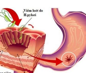 Tìm hiểu chi tiết về bệnh viêm dạ dày