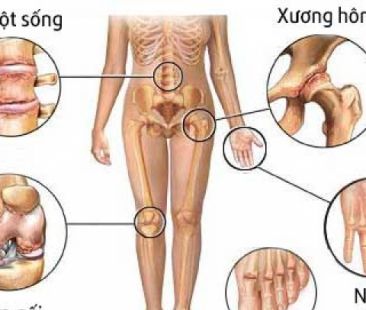 Tìm hiểu triệu chứng thực thể bệnh cơ xương khớp