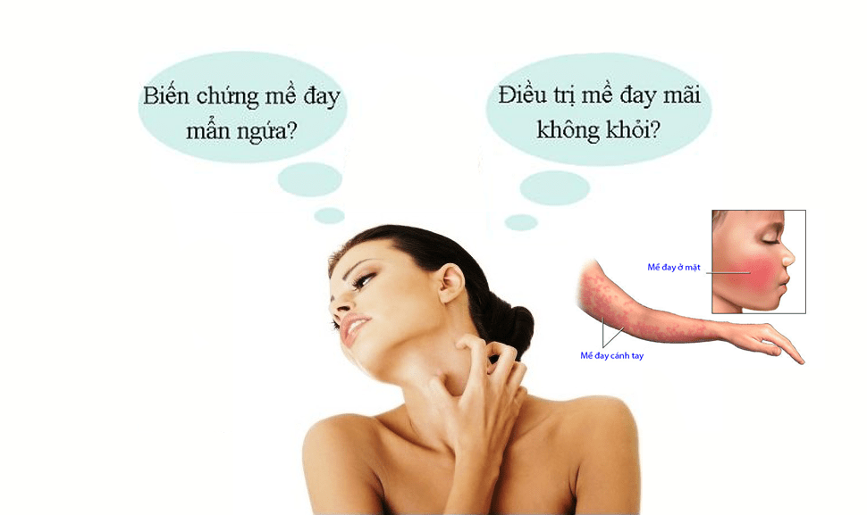 Chữa mề đay tận gốc nhờ những mẹo đơn giản