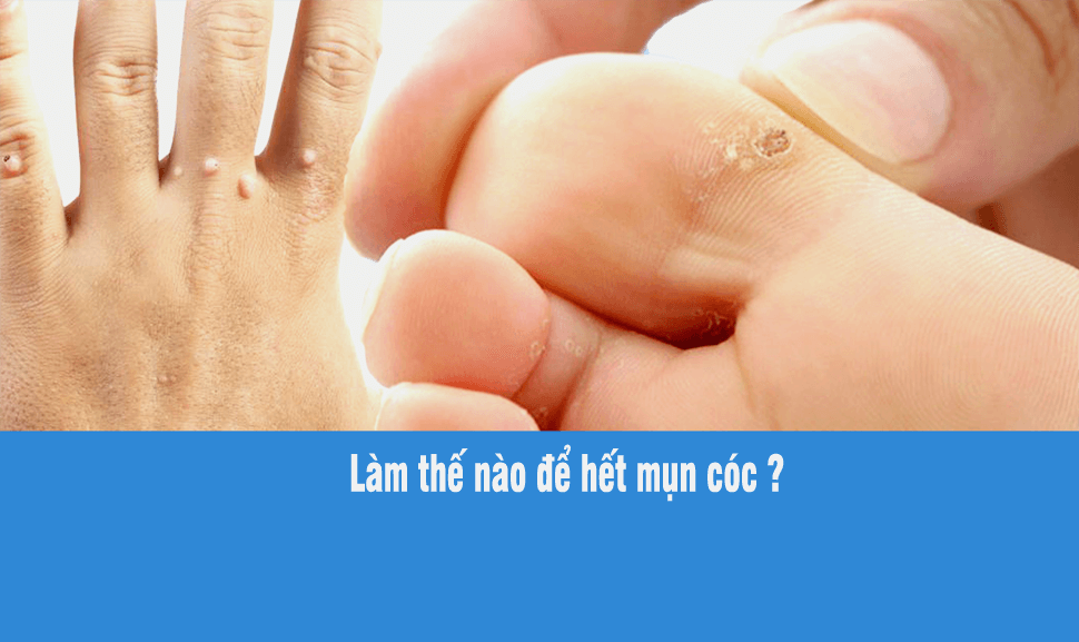 Chữa mụn cóc bằng phương pháp dân gian đơn giản cực hiệu quả