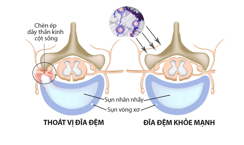 THOÁT VỊ ĐĨA ĐỆM