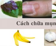 Cách chữa mụn cóc cực hiệu quả mà bạn nên biết