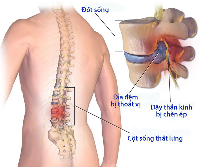 Hình ảnh mô tả về bệnh thoát vị đĩa đệm