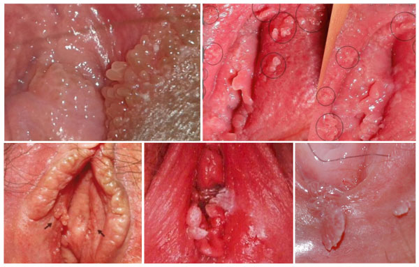 Các biểu hiện của sùi mào gà ở nữ giới