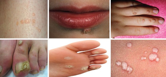 Các loại mụn cóc ở nhiều vị trí trên cơ thể