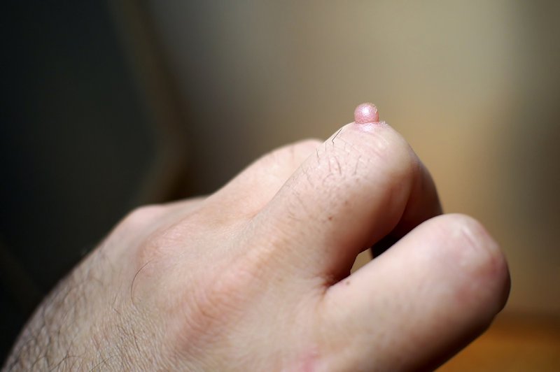 Mụn cóc có thể lây truyền 