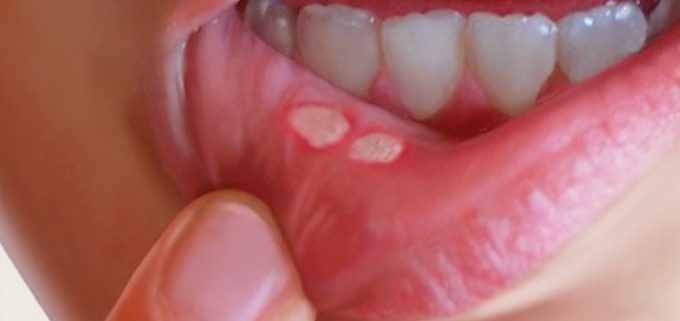 Bạn biết gì về sùi mào gà ở miệng