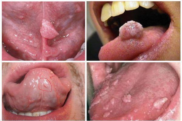Vài đặc điểm nhận diện sùi mào gà ở miệng