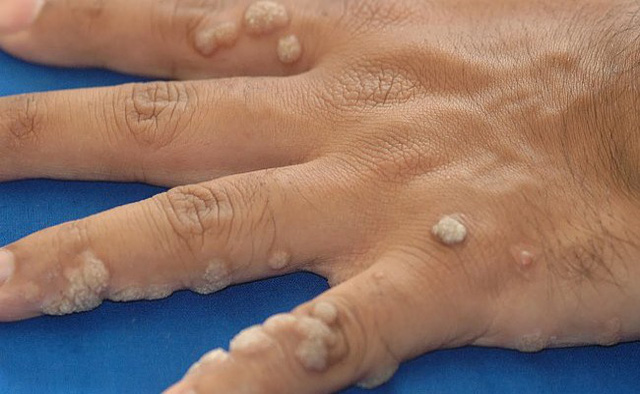 Mụn cóc xuất hiện nhiều cũng là dấu hiệu của ung thư da
